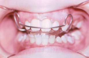 Ortho%20Overbite%20Intratreatment%20With%20Appliance.jpg